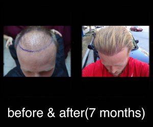 Nader Medical, Hair restoration, hair transplant, fue hair, chris ryan nyc